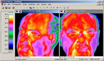 ThermArray images of Carotid artery